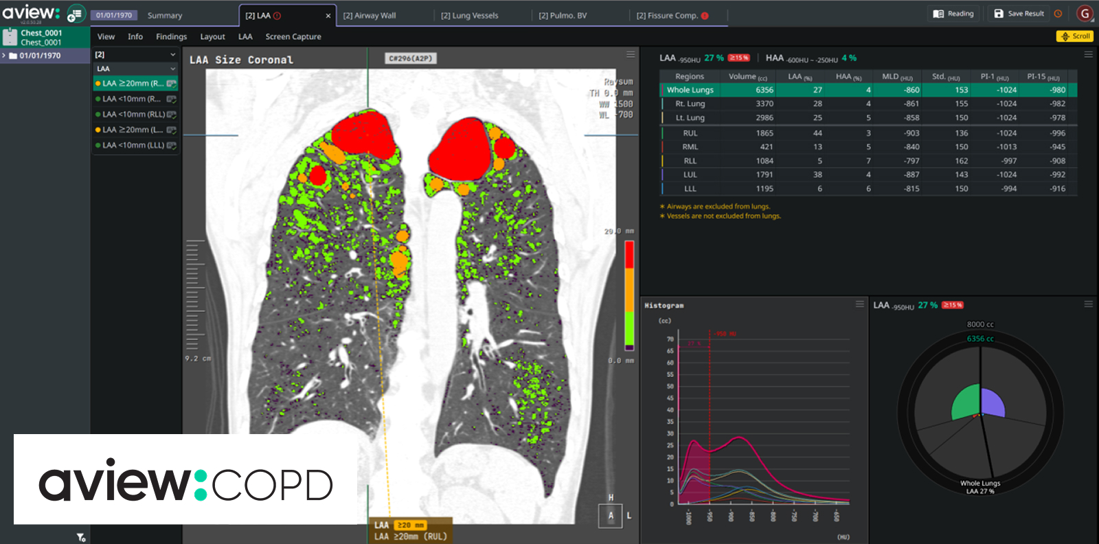 COPD