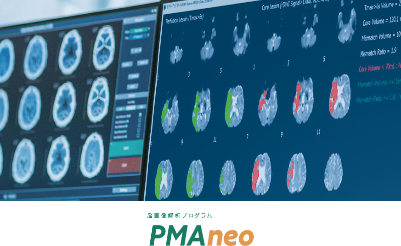 stroke (cerebral infarction)