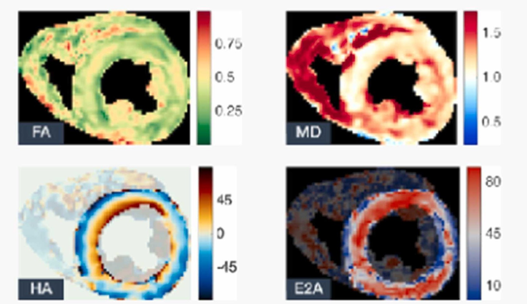 Mean diffusivity (MD) 、 Fractional anisotropy (FA)、Helix angle (HA)、Transverse angle (TA)、Sheetlet angle (E2A)